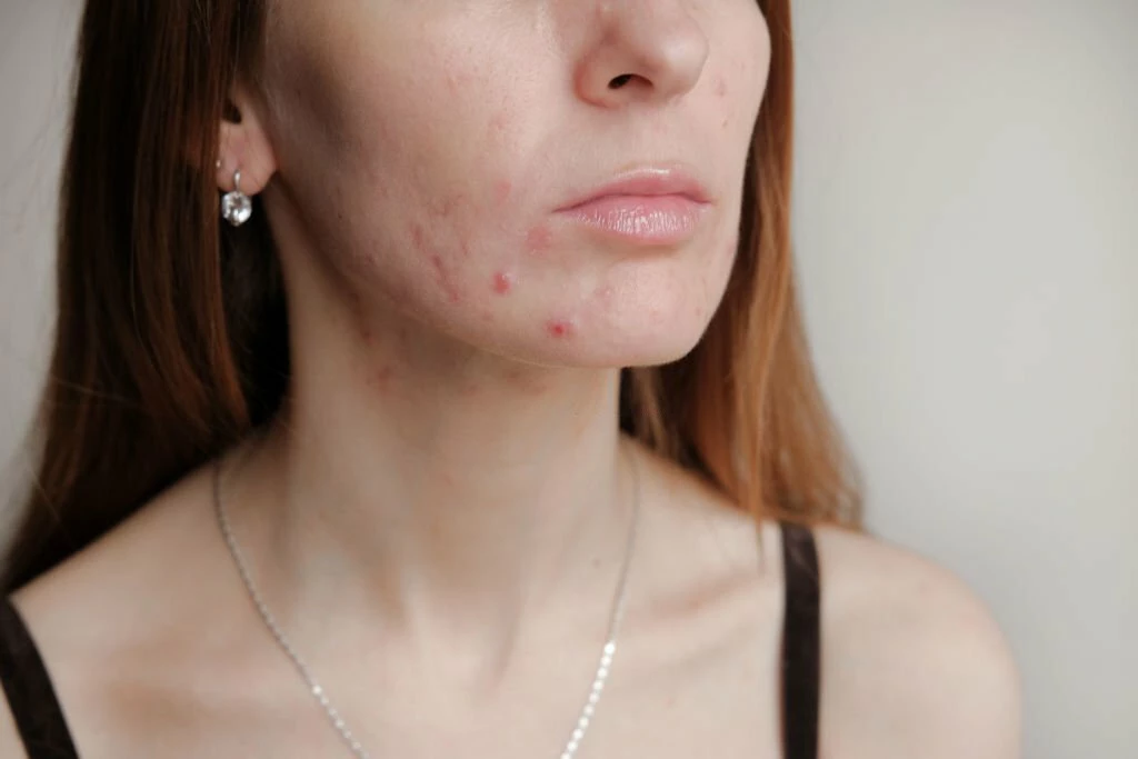 Say Goodbye to Acne Scarring Reclaim Your Radiant Skin